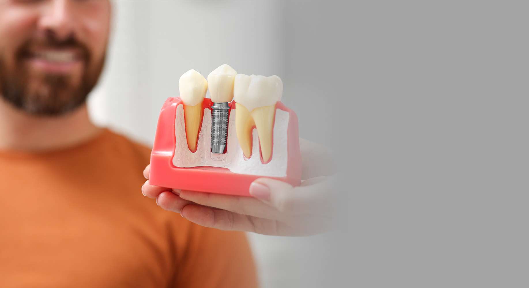 Dental Implants with Abutments and Crowns